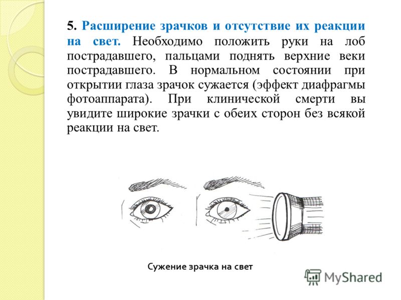 Какие зрачки у мертвого человека фото