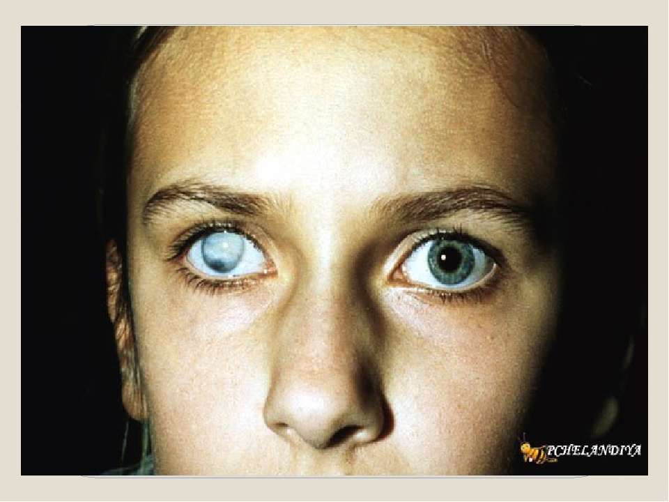Почему у людей есть глаза. Васкуляризированное бельмо.
