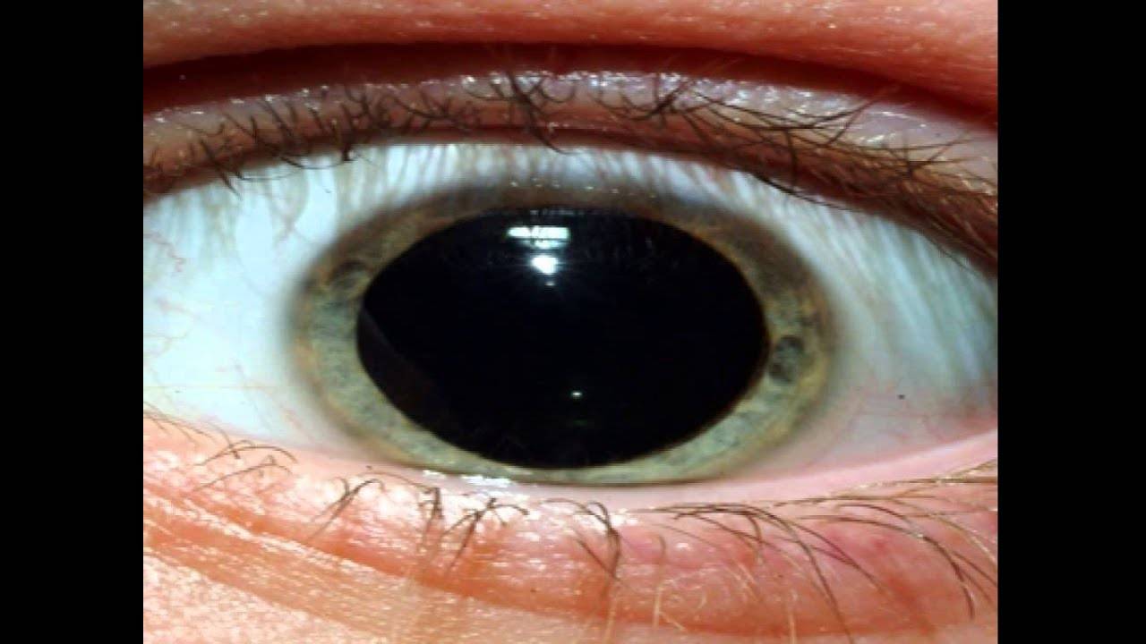 Расширяет зрачки расширяет просвет сосудов кожи. Паралитический мидриаз. Глаз расширенный зрачок. Расширенные зрачки причины.